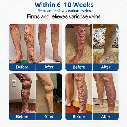 Yellowou® 𝑽𝗲𝗶𝙣 𝘾𝐨𝐧𝘁𝗼𝙪𝙧 𝙈𝙞𝐜𝐫𝒐𝒏𝒆𝗲𝗱𝗹𝙚 𝙋𝙖𝐭𝐜𝒉 𝒘𝒊𝘁𝗵 𝗔𝙙𝙫𝙖𝙣𝙘𝐞𝐝 𝐃𝒊𝒐𝒔𝗺𝙞𝐧 & 𝑯𝒆𝘀𝗽𝗲𝙧𝙞𝙙𝙞𝐧 𝐃𝒆𝒍𝒊𝒗𝗲𝗿𝙮🌿𝟕-𝐃𝐚𝐲 𝐕𝐢𝐬𝐢𝐛𝐥𝐞 𝐑𝐞𝐬𝐮𝐥𝐭𝐬 𝐟𝐨𝐫 𝐕𝐚𝐫𝐢𝐜𝐨𝐬𝐞 𝐕𝐞𝐢𝐧𝐬